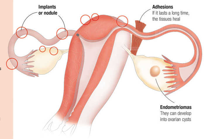 How does endometriosis affect your fertility?