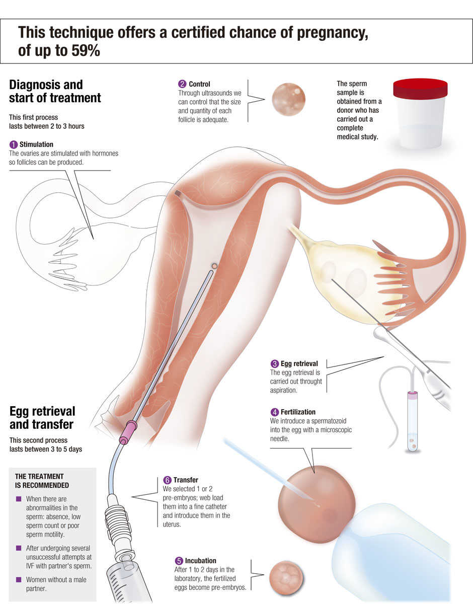 In vitro fertilisation using your own eggs and your partner’s sperm, step by step