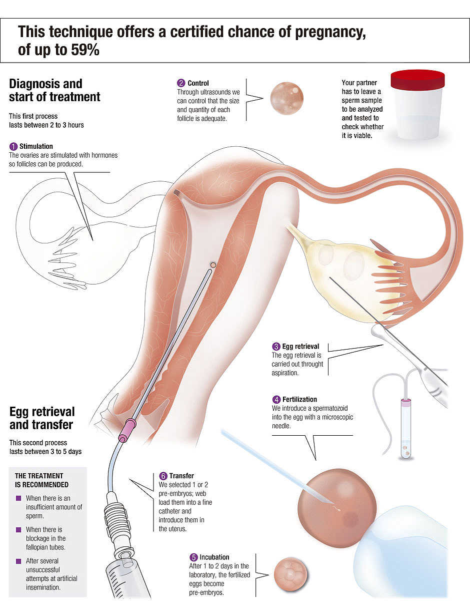 In vitro fertilisation using your own eggs and donor sperm, step by step