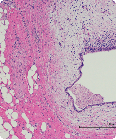 que-es-la-endometriosis